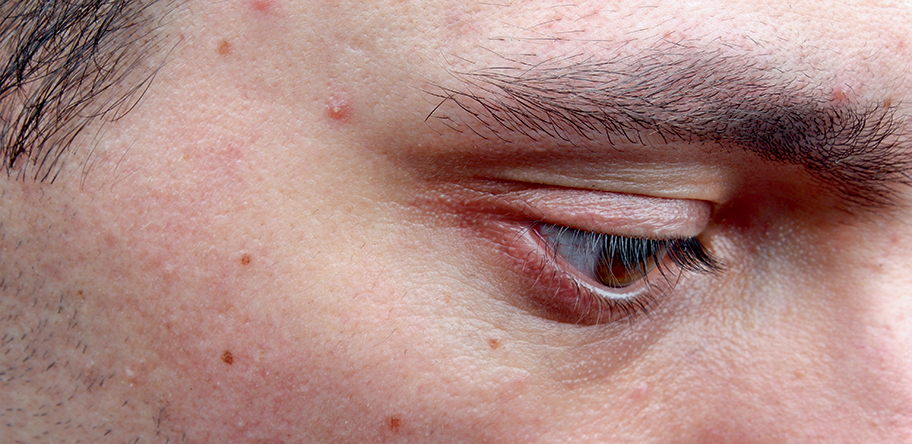 70% of patients with persistent acne test positive for insulin resistance