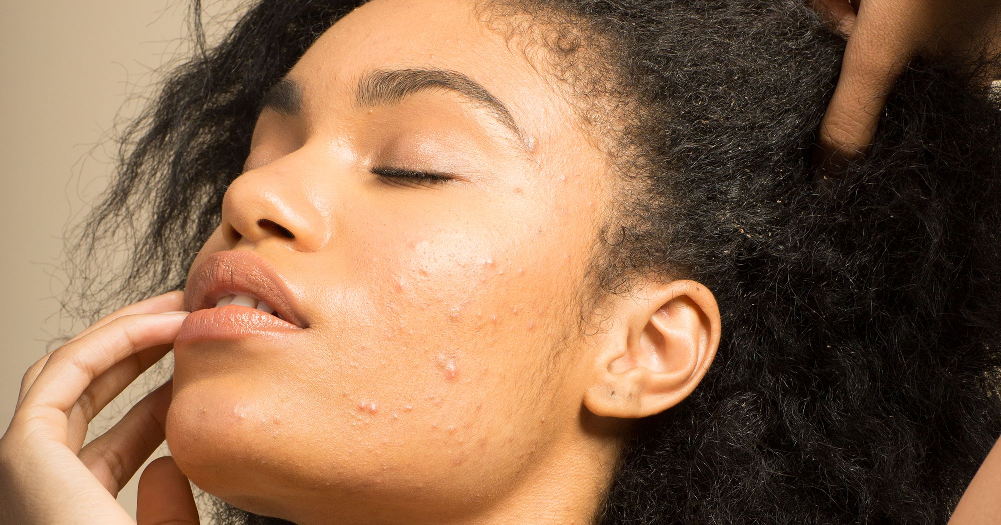 This Is Proof That Birth Control Could Be A Game-Changer For Your Acne