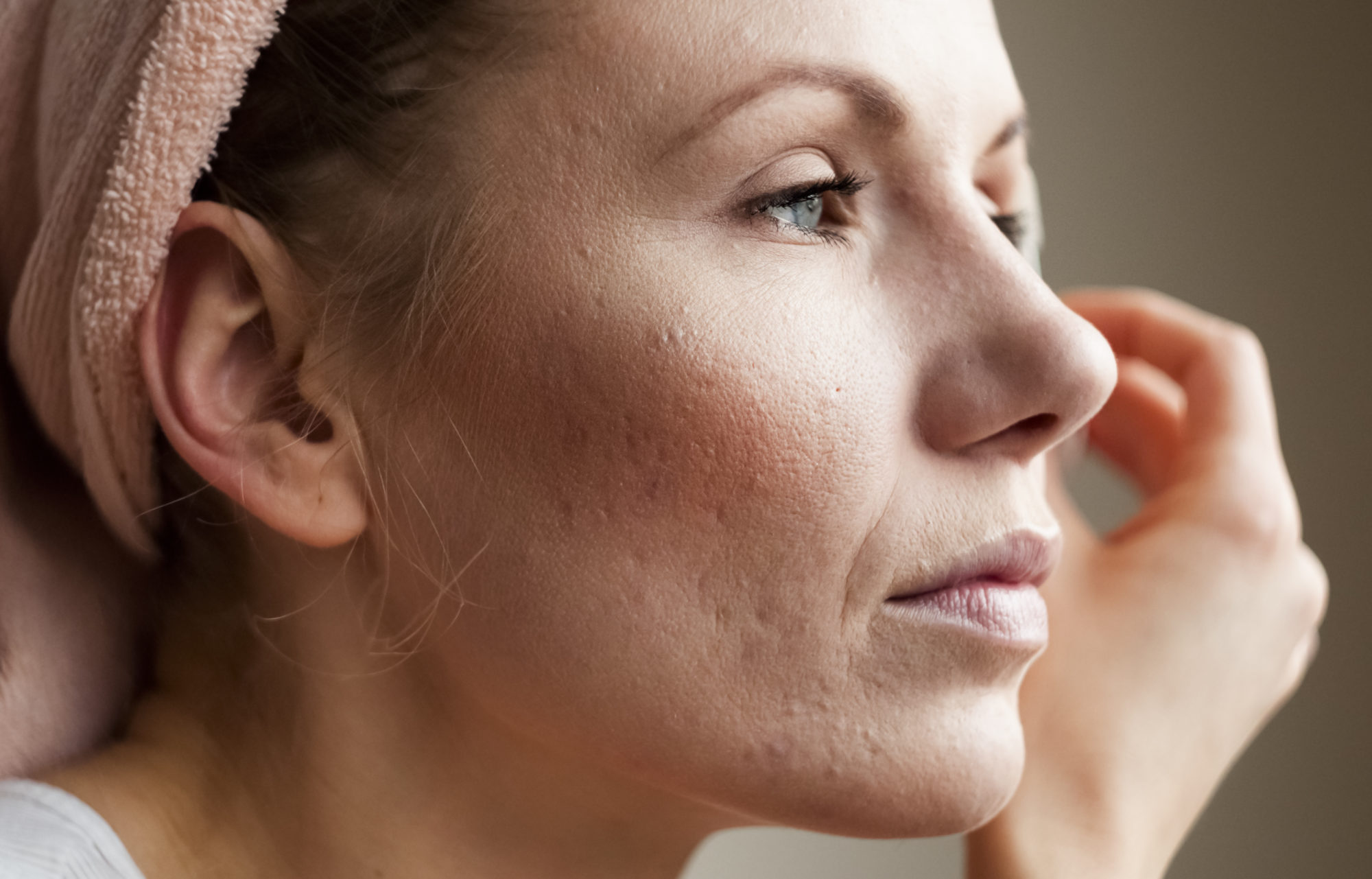 Common Acne Causes In Adults
